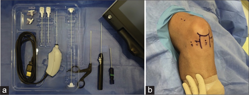 The role of in-office needle arthroscopy in orthopedic practice: A review