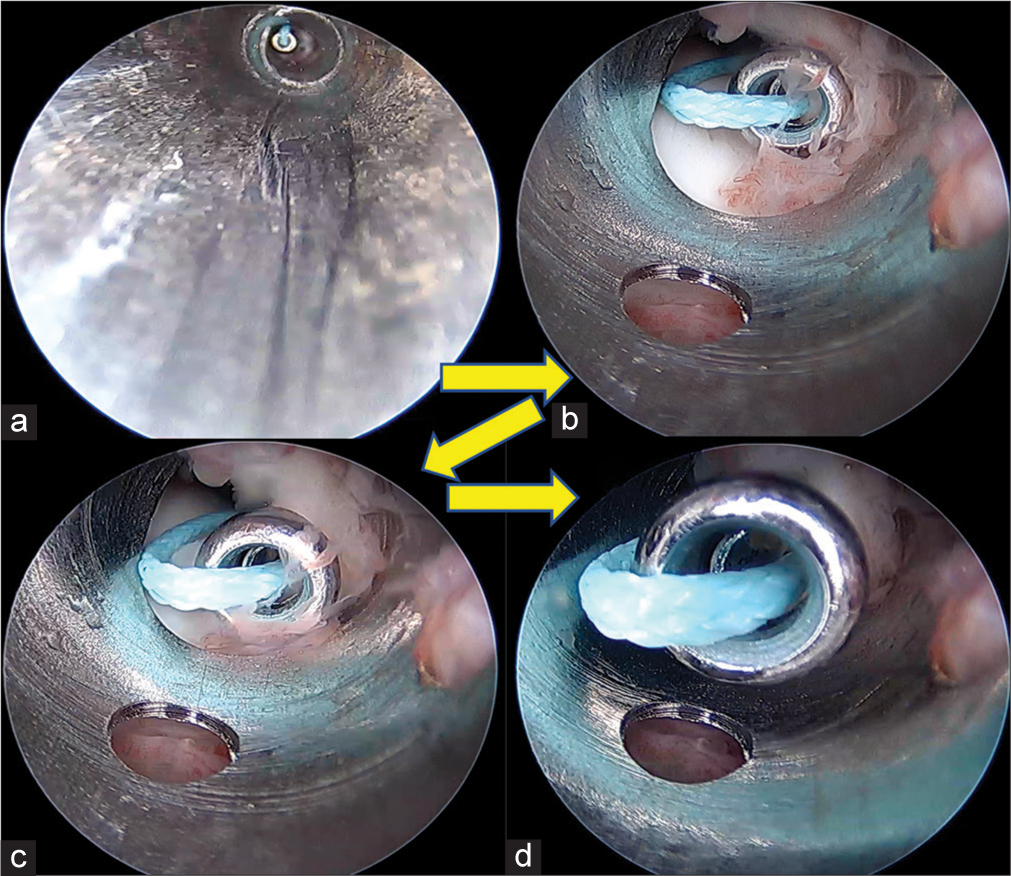 Anterior soft tissue retraction during arthroscopy of the ankle