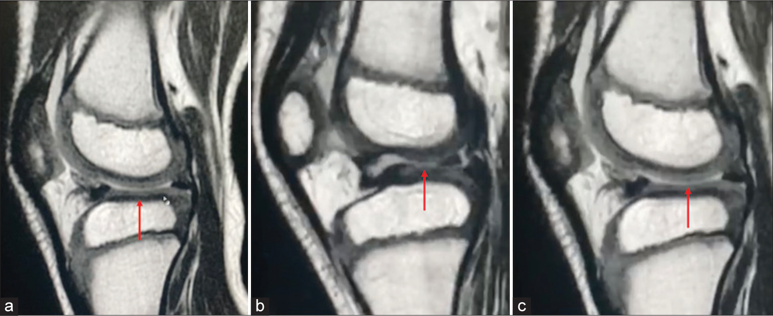 Congenital absence of anterior and posterior cruciate ligaments – A rare case report and review of literature