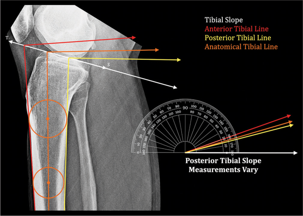 A novel “Precision technique” for preoperative planning of posterior tibial slope correction osteotomy