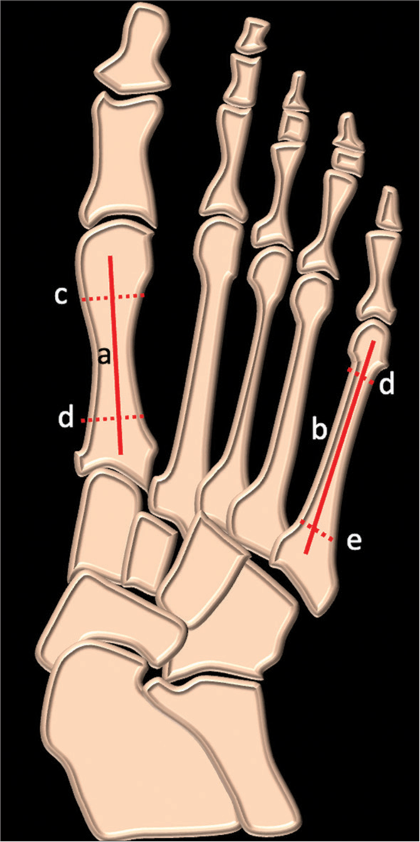 Pes planus intermetatarsal angle to measure flatfoot deformity on dorsoplantar radiographic imaging