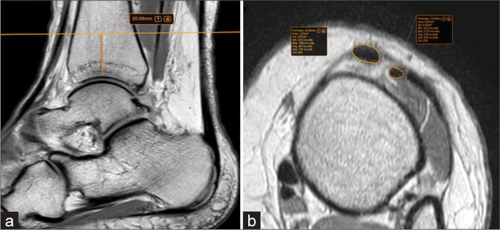 Cross-sectional area correlation of anterior tibial tendon and extensor hallucis longus tendon: A diagnostic approach for anterior tibial tendon dysfunction