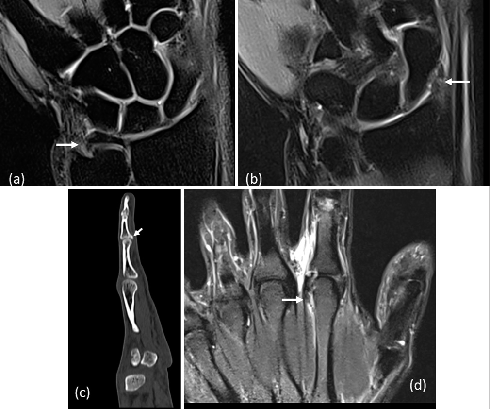 Imaging in elite and recreational cricket injuries: A pictorial review