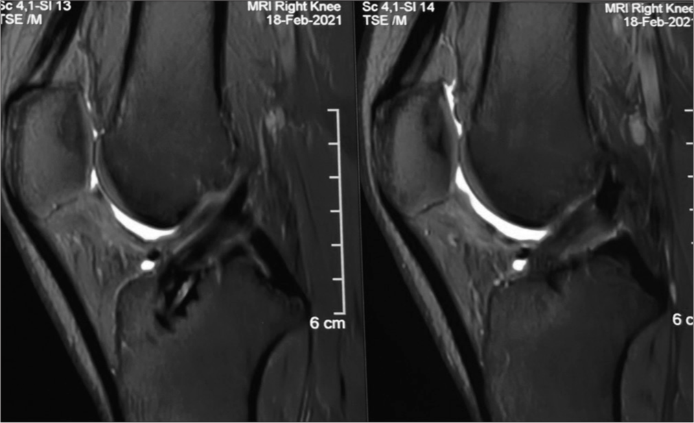 Graft fixation techniques in anterior cruciate ligament reconstruction – A narrative review