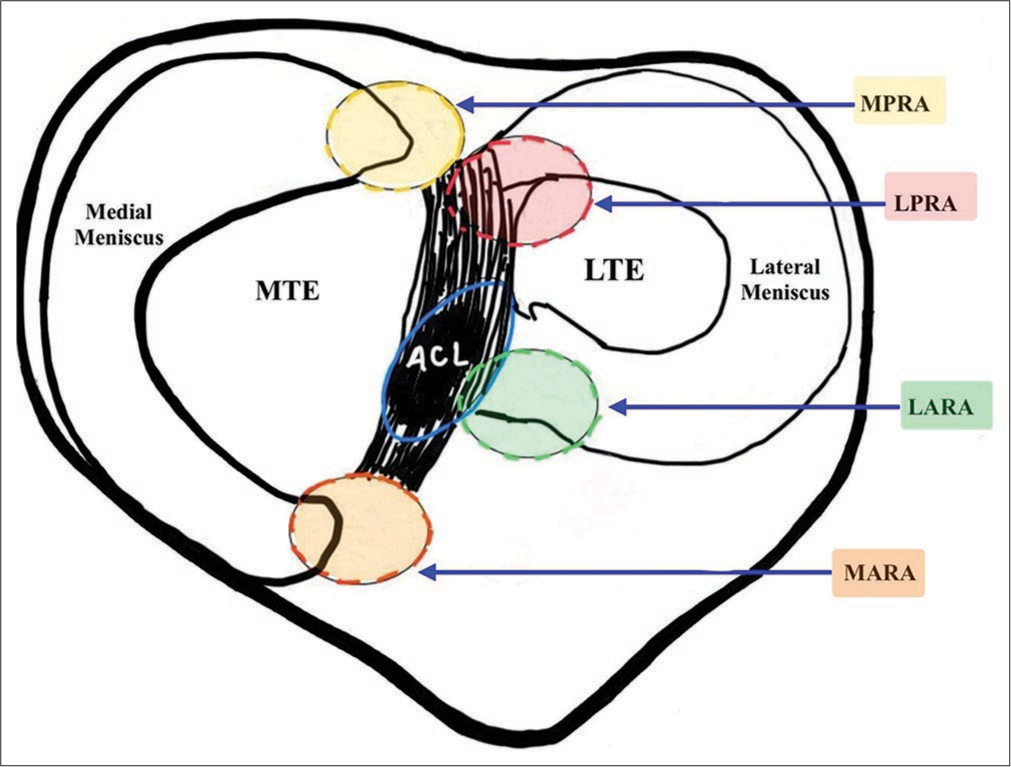 Medial meniscal posterior root tear – A current concept review