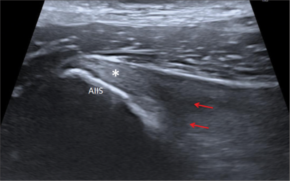 The straight head of rectus femoris: An underdiagnosed cause of chronic pain post hip replacement