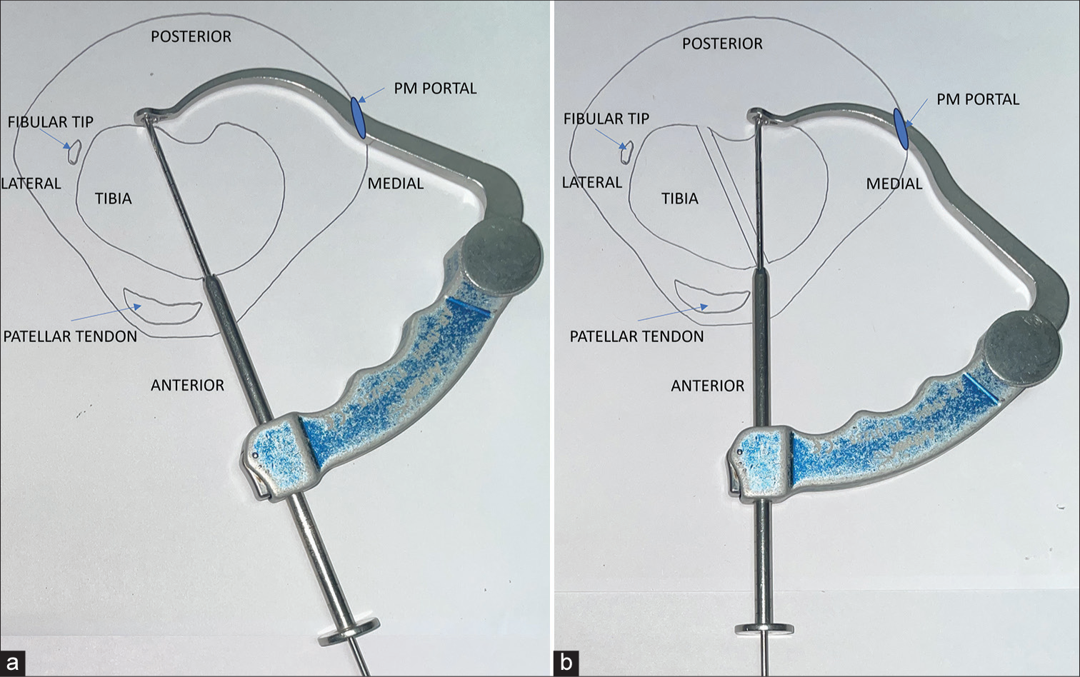 Arthroscopic intercruciate trans-septal posterior cruciate ligament avulsion fixation with pull-through technique using a single button adjustable loop device