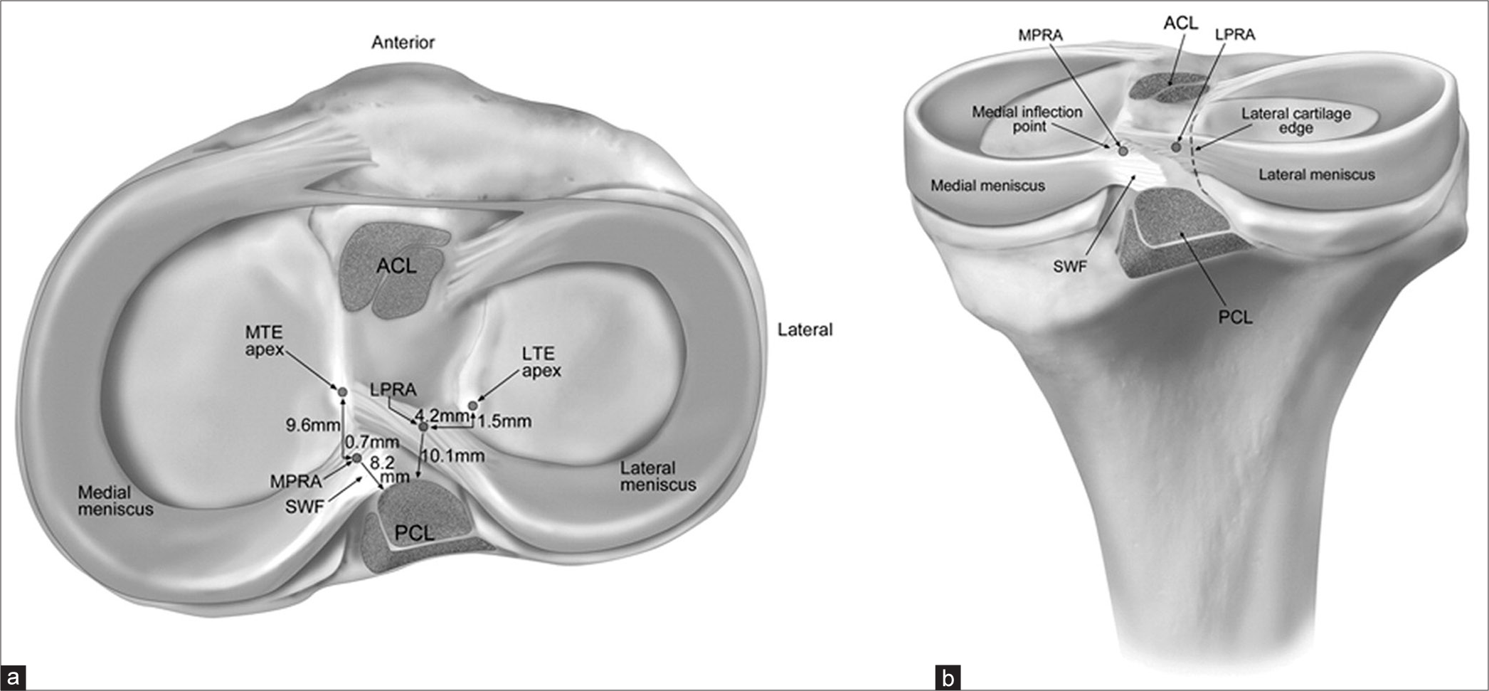 Current concepts on the surgical treatment of ramp, root, and radial meniscal tears