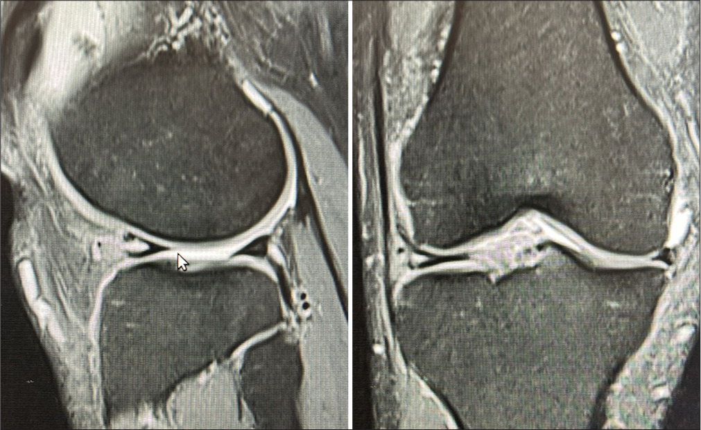 A novel arthroscopic repair method for anterior horn of the lateral meniscus horizontal tear with all-suture anchor