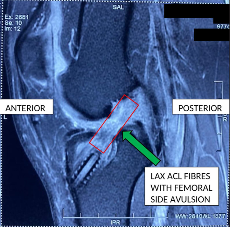 Single-stage revision anterior cruciate ligament reconstruction for anatomic, massive dilated tunnels using “the sandwich technique”