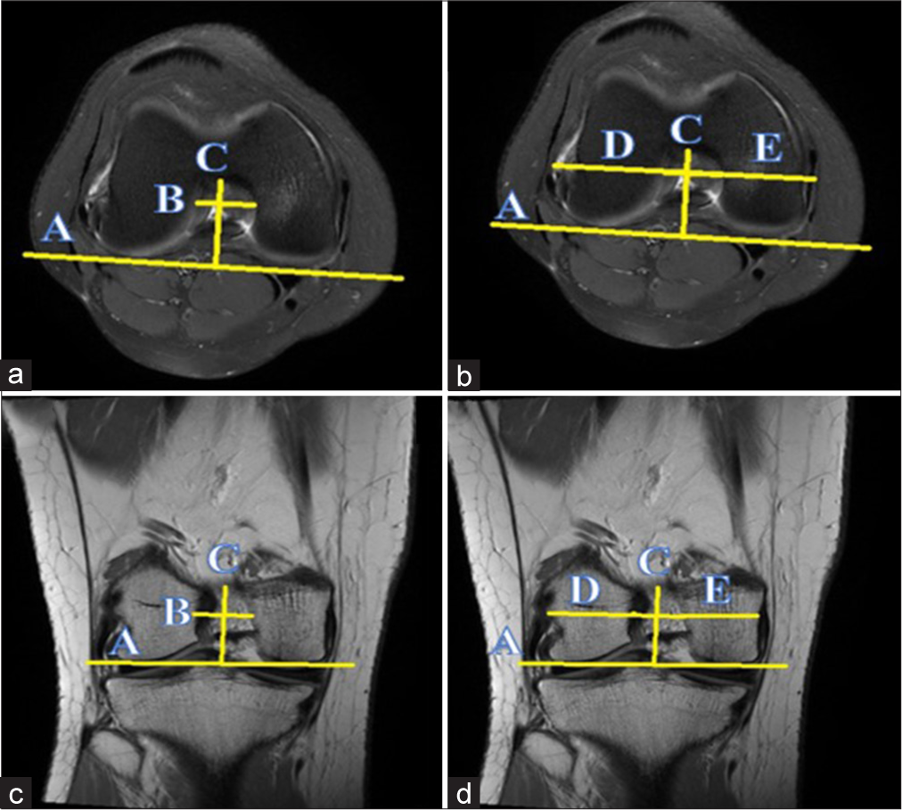 Triangular notch morphology in young males linked to increased risk of non-contact anterior cruciate ligament tears