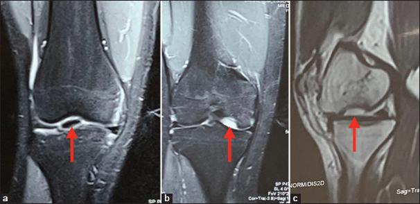 Anatomical and cost-effective technique of fixation of osteochondral defect of femur with absorbable sutures