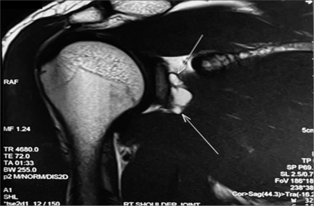 Paralabral cyst in cricketers – A case series