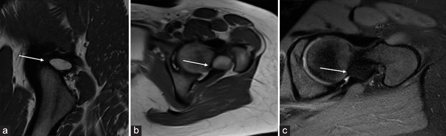 Intra-articular lipoma of the hip joint – A report of two cases and literature review