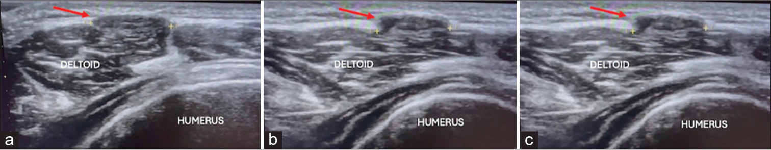 Deltoid muscle hernia: An unusual site of myofascial hernia