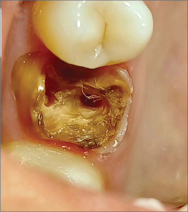 Management of dislodged crown using split cast metal post and core: A case report