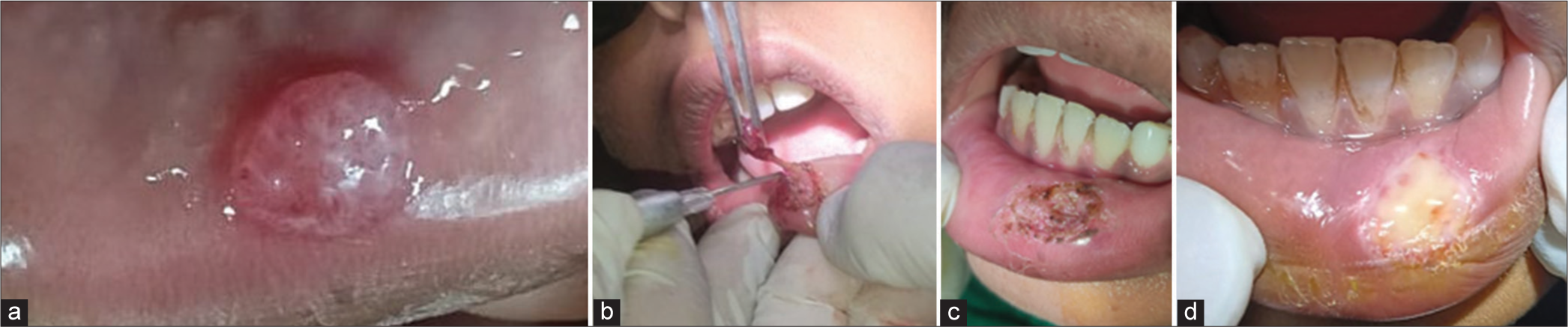 Diode laser-assisted excision of mucocele: A case series