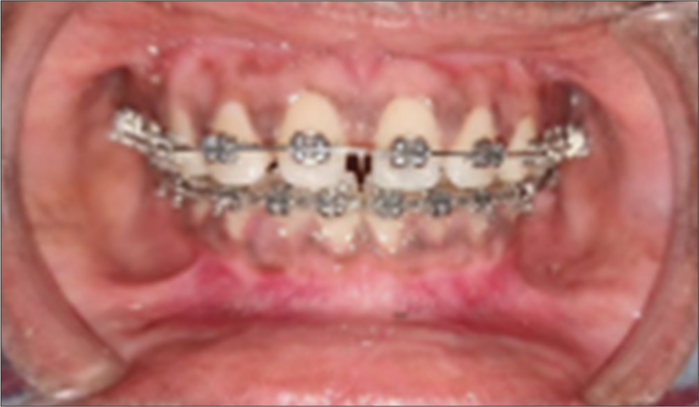 Advancement in periodontal accelerated osteogenic orthodontics: Exploring the synergy between periodontal and orthodontic treatment – A case report