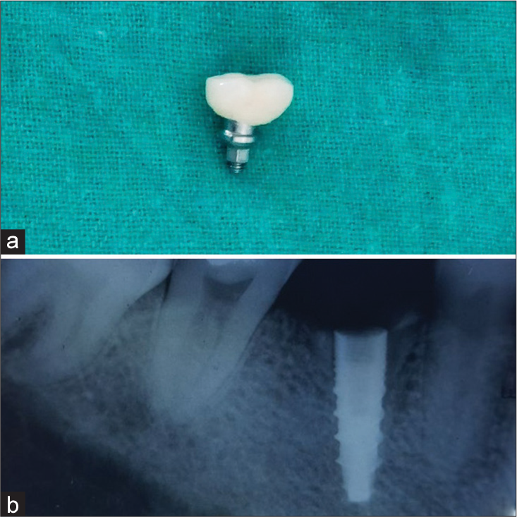 A novel technique for retrieval of cement-retained crown from an implant abutment and converting it into a combination prostheses