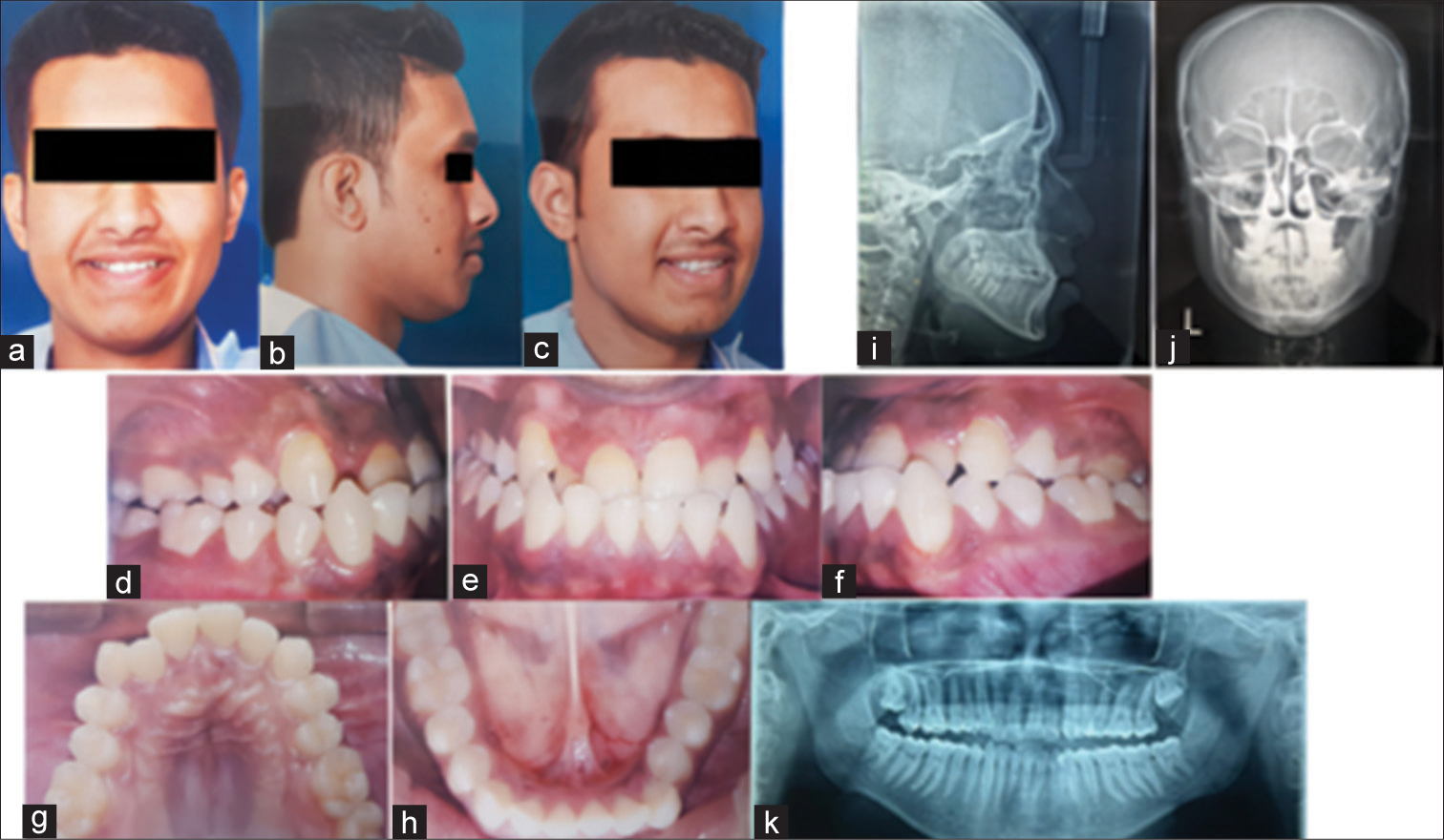 Treatment modalities for management of skeletal and dental Class III malocclusion – A case series