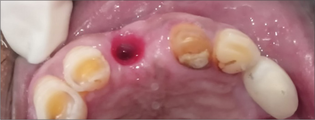 Custom healing abutments: A practical approach for deep subgingival implants