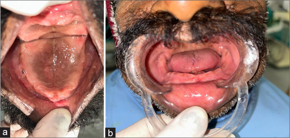 A simplified approach for management of flabby ridge