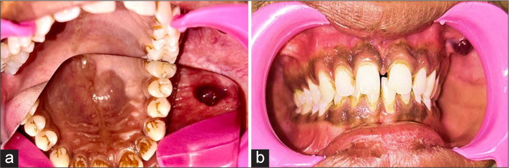 Angina bullosa hemorrhagica: A rare and benign oral mucosal disorder – A case report
