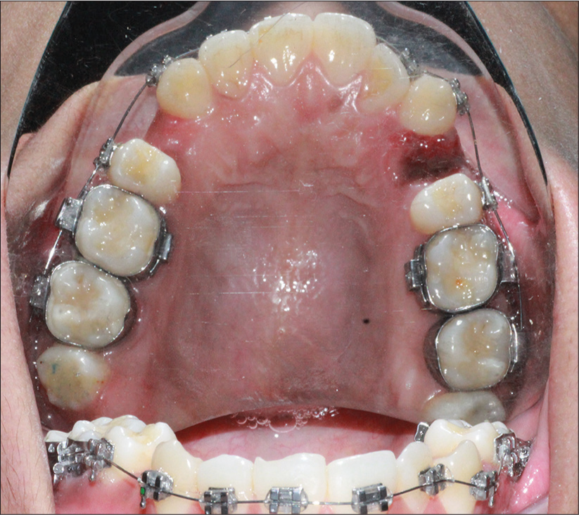 Efficacy of Piroxicam and Tramadol for Relieving Pain Associated with Therapeutic Dental Extractions followed by Immediate Archwire Loading during Orthodontic Treatment: A Cross-Over Randomized Clinical Trial