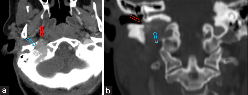Glomus jugulotympanicum tumor treated with radiation therapy: A case report with review of literature