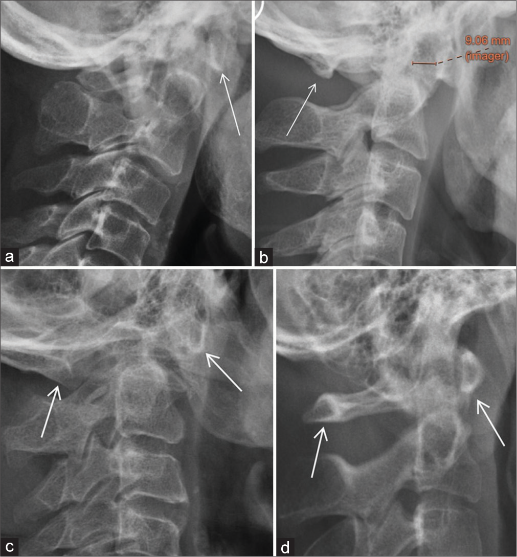 Atlanto-occipital assimilation: A pictorial review of a commonly missed pathology