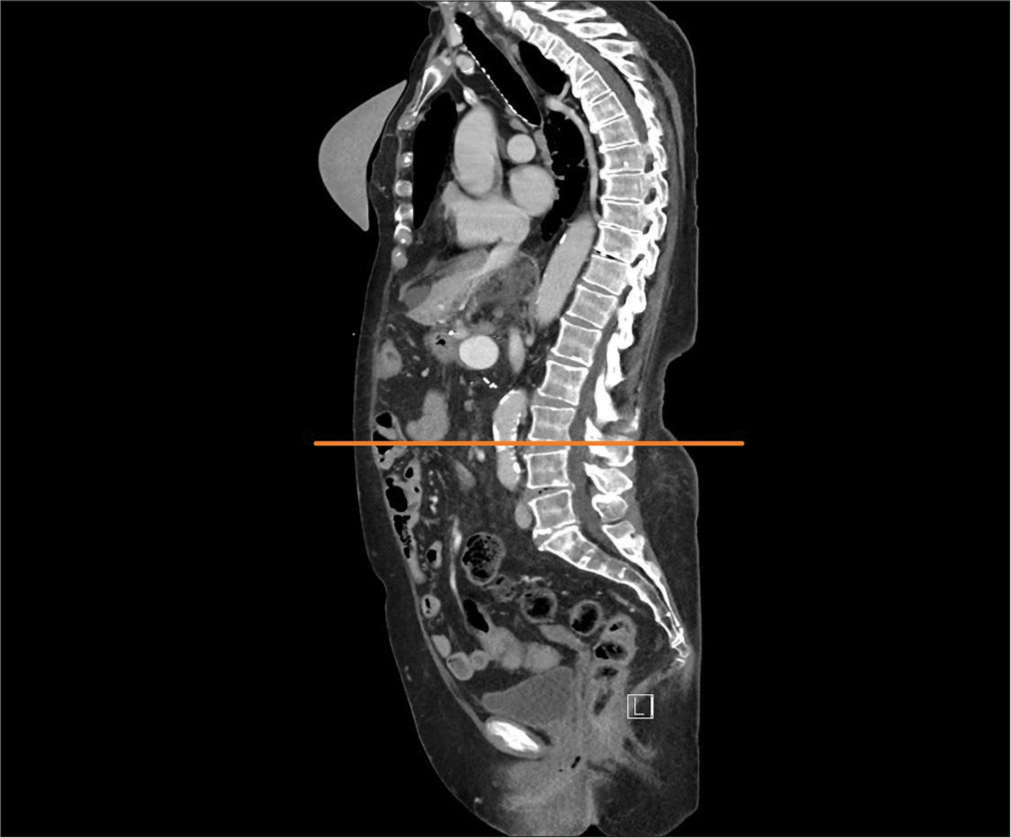 Does computed tomography-derived volumometry and densitometry of psoas muscle really correlate with complications in rectal cancer patients after elective surgery?