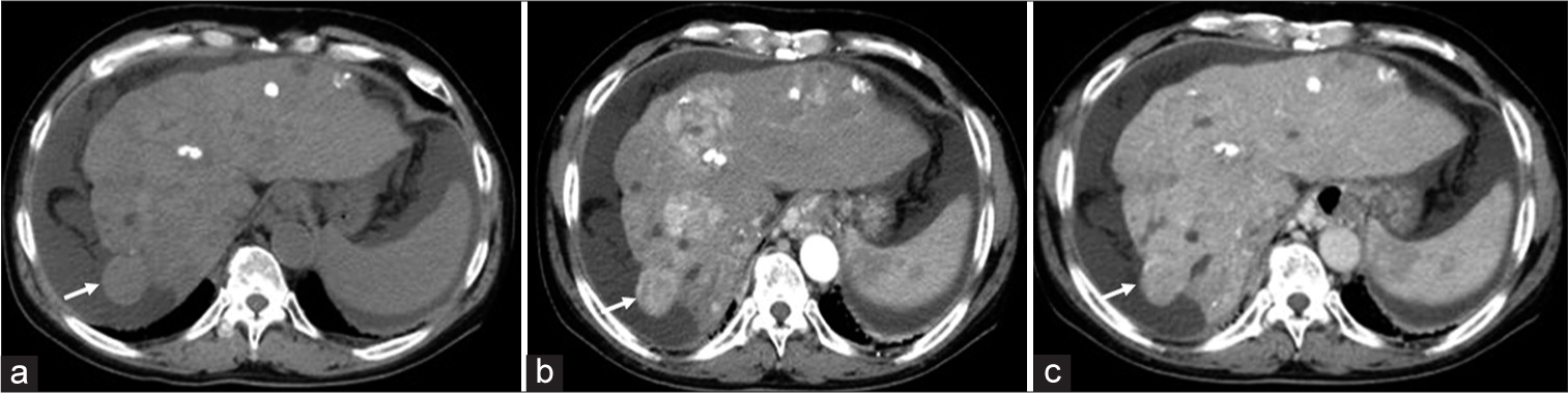 Interruption during drug-eluting beads transarterial chemoembolization procedure by presumed allergic shock requires careful follow-up on the development of vascular lake phenomenon