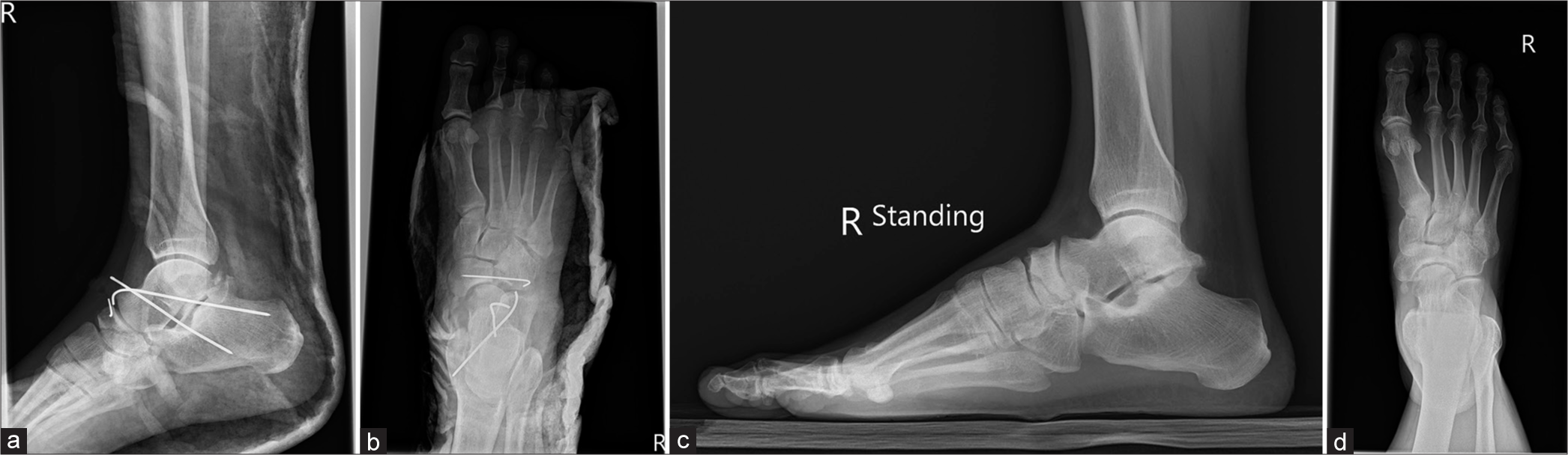 Acute traumatic subtalar dislocation: A rare but important clinical entity with 15-year retrospective radiological analysis of 23 cases