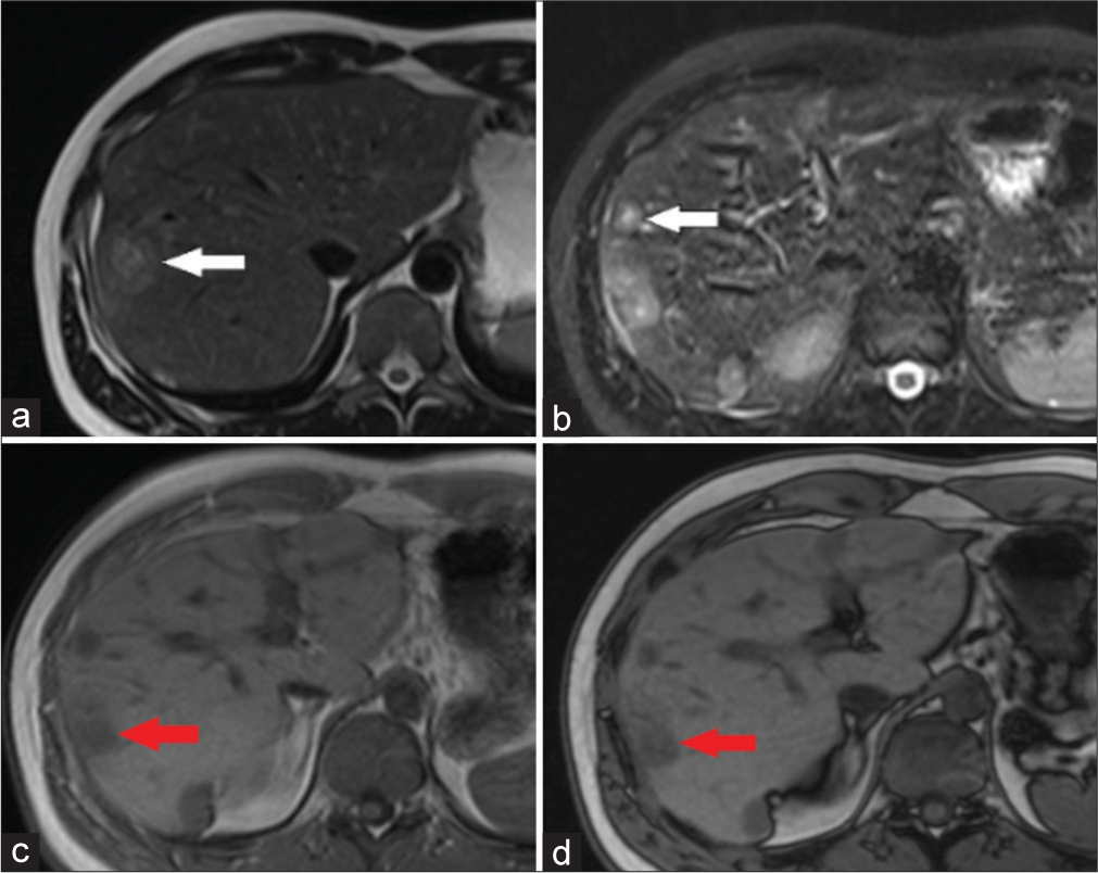 MRI and PET/CT of multiple primary hepatic angiosarcomas in 25-year-old man: A case report