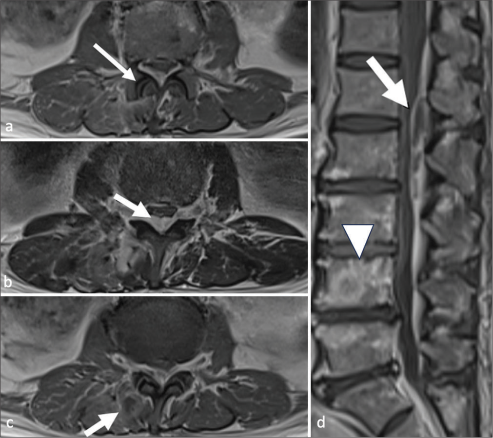 Facet joint septic arthritis: A review of cases