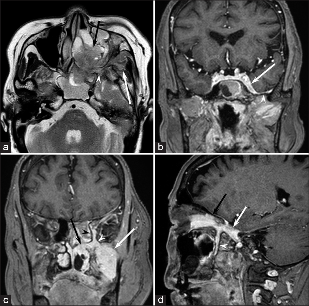 Computed tomography and magnetic resonance imaging findings of intracranial and extracranial meningioma with perineural spread through the foramen rotundum: A case report