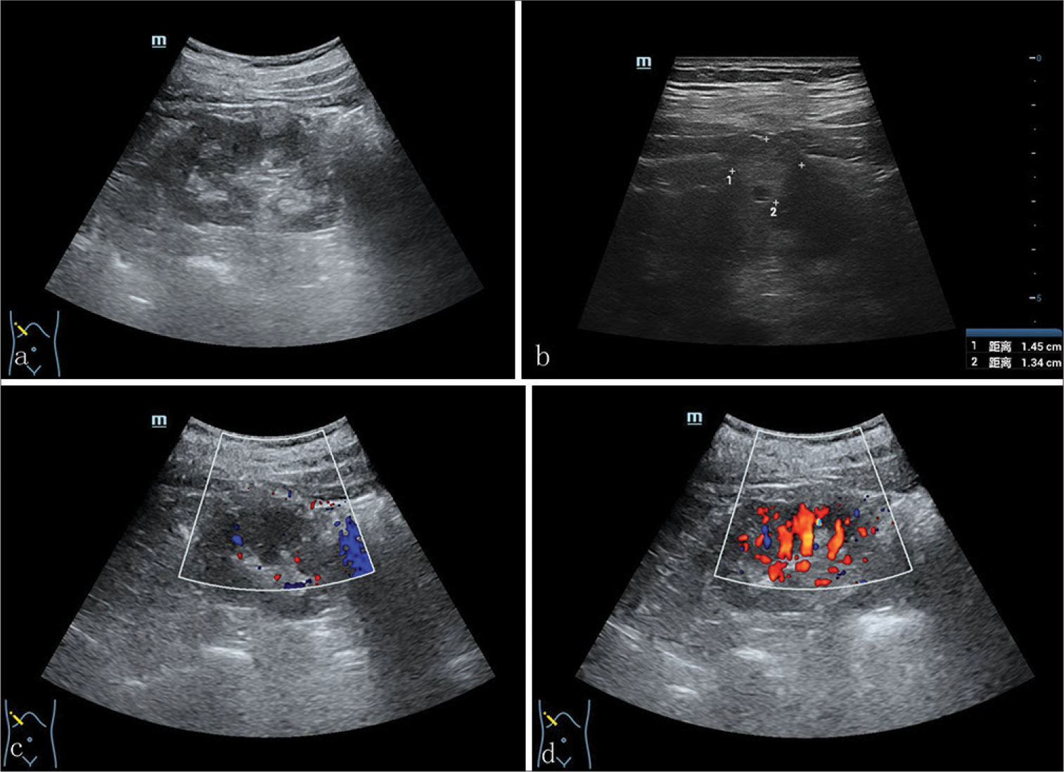 Multimodal imaging findings of tubulocystic renal cell carcinoma: A case report