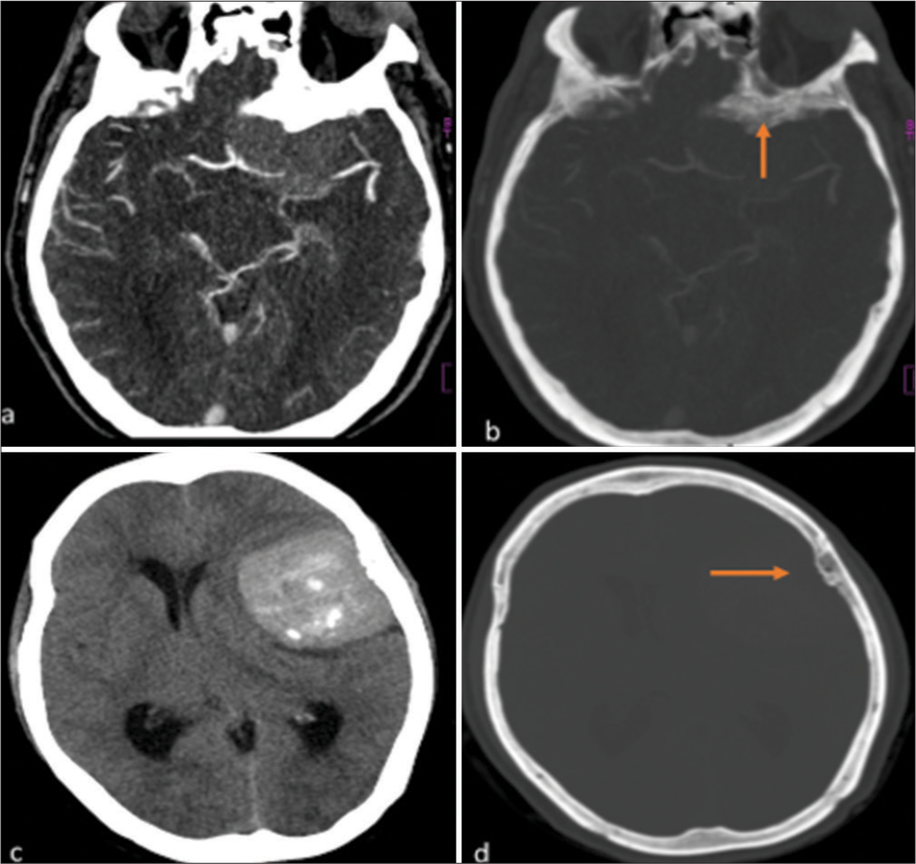 Magnetic resonance imaging spectrum of intracranial meningiomas: An institutional review of common and uncommon imaging appearances