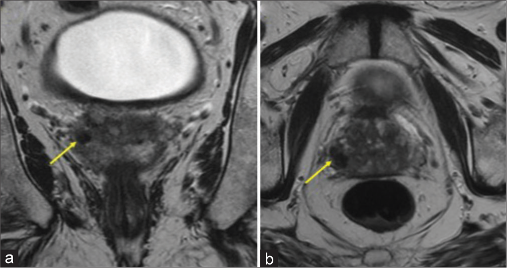 Granulomatous prostatitis following Bacillus Calmette–Guérin therapy