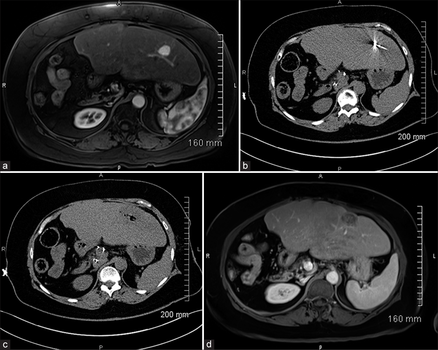 Percutaneous microwave ablation for early-stage intrahepatic cholangiocarcinoma: A single-institutional cohort