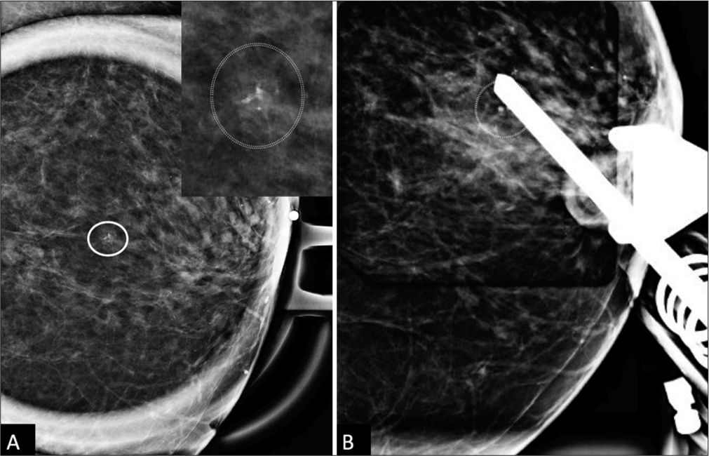 Granulomatous mastitis following stereotactic core-needle biopsy: A case report