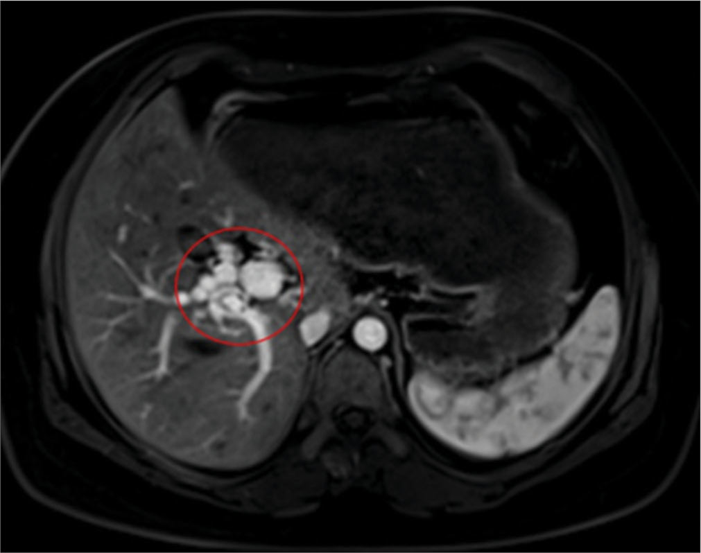 Three main portal veins: A very rare case of portal vein anomaly