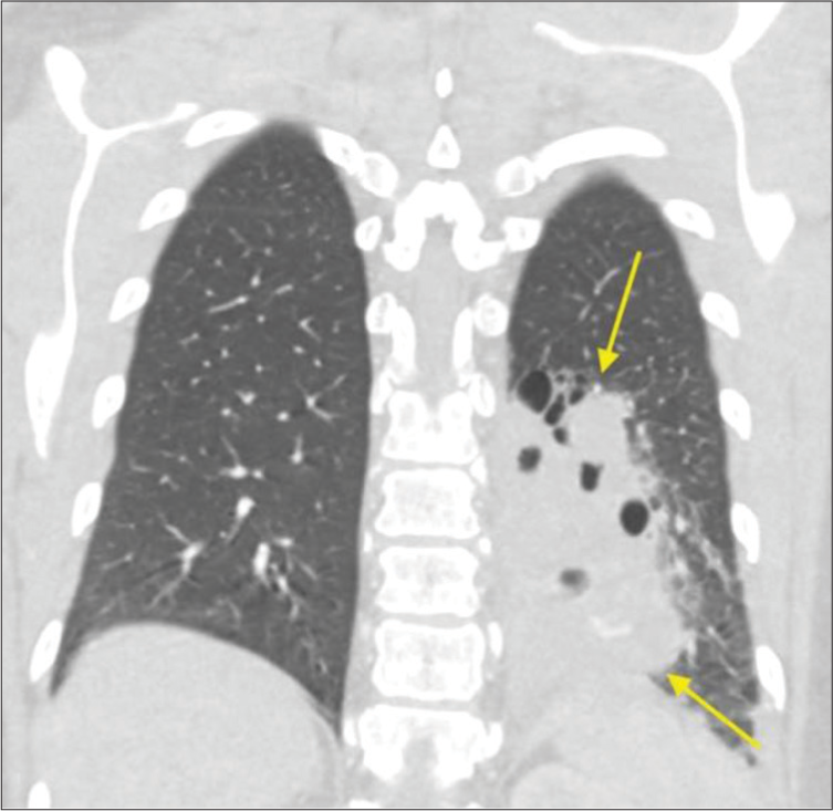 Transarterial embolization of intralobar pulmonary sequestration in adult patients: A case series