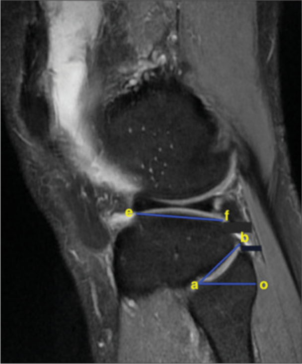 Morphometric evaluation of the proximal tibiofibular joint among patients with knee joint pain: A pilot study and literature review