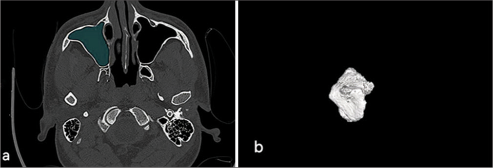 Volumetric analysis of maxillary sinus and assessment of various sinonasal anatomic variants on multi-detector computed tomography (MDCT) and their association with chronic rhinosinusitis