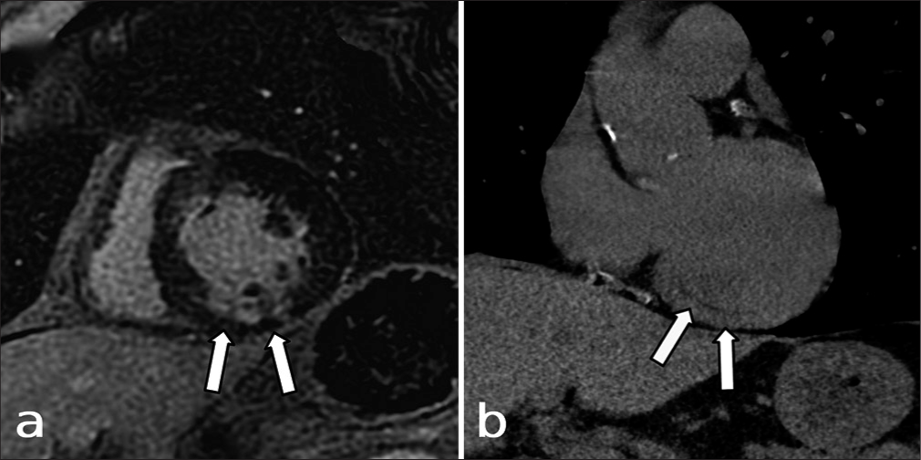 Frequency of myocardial infarcts on conventional, non-gated CT: An often-overlooked entity