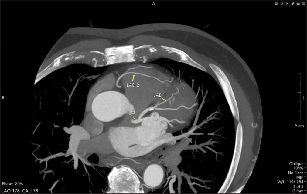 Dual left anterior descending artery: A case report