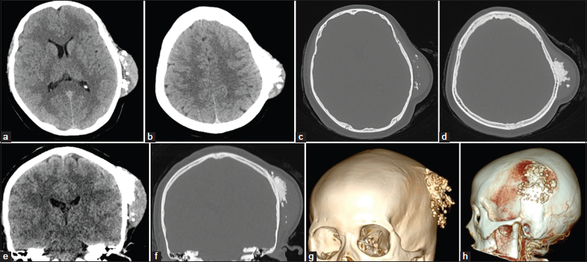 Desmoplastic (collagenous) fibroma of the parietal bone: Case report and review of the literature