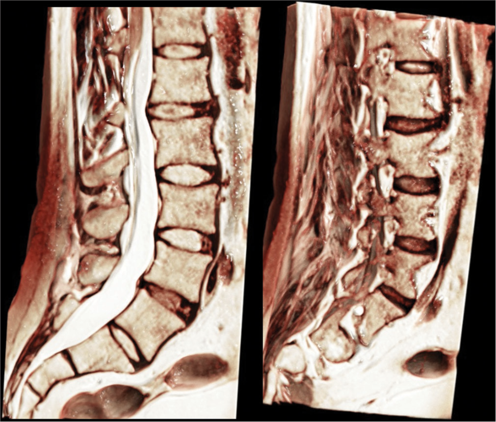 Pixels to precision: Neuroradiology’s leap into 3D printing for personalized medicine