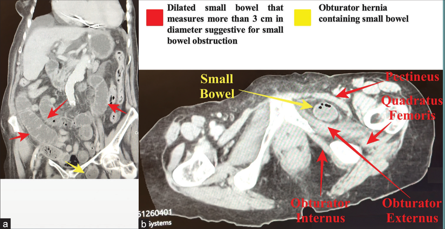 Emergency transabdominal preperitoneal (TAPP) repair of a strangulated obturator hernia: A literature review and video vignette